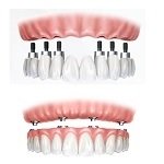 implant diş fiyatları