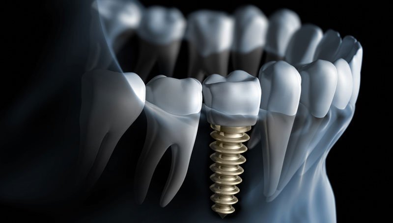 implant diş ücreti