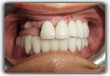 implant üstü diş