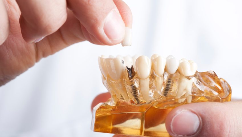 implant diş tedavisinin avantajları