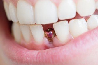 implant diş nedir
